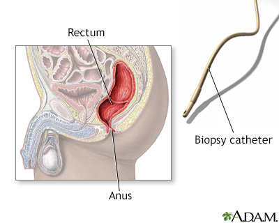 Rectal biopsy