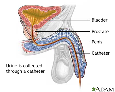 Catheterization