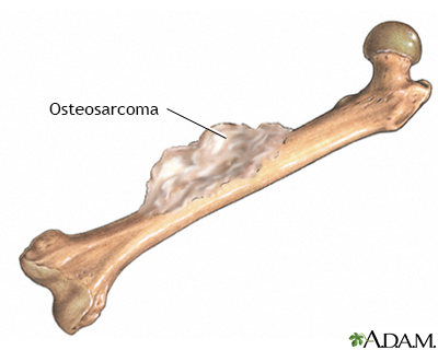 Bone tumor