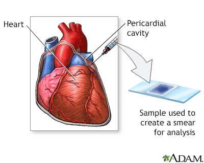 Pericardial fluid culture