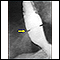 Schatzki ring - x-ray