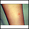 Chickenpox - lesion on the leg