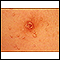 Molluscum contagiosum - close-up of the chest