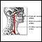 Carotid artery surgery - series