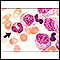 Chronic myelocytic leukemia - microscopic view