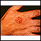 Bowen's disease on the hand