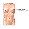 Breast reconstruction - series - Indication, part 1