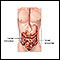 Intestinal obstruction repair - series