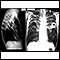 Tuberculosis, advanced - chest X-rays