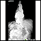 Hiatal hernia - X-ray