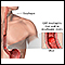 CMV esophagitis