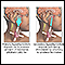 Primary and secondary hypothyroidism