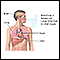 Disseminated coccidioidomycosis