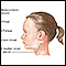 Infectious mononucleosis