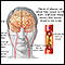 Atherosclerosis of internal carotid artery