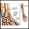 Fractures across a growth plate