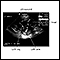 Ultrasound, normal fetus - ventricles of brain