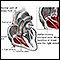 Tricuspid Regurgitation