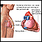 Bacterial pericarditis