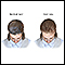 Female-pattern baldness