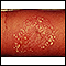 Pustules - superficial on the arm