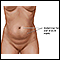 Abdominoplasty - series