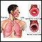 Asthmatic bronchiole and normal bronchiole