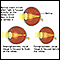 Normal, nearsightedness, and farsightedness