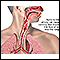 Airway burn