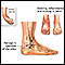 Ankle sprain