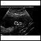 Ultrasound, normal fetus - foot