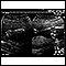 Ultrasound, normal fetus - arms and legs