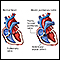 Absent pulmonary valve