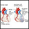 Anomalous left coronary artery