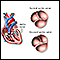 Bicuspid aortic valve