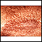 Acanthosis nigricans - close-up