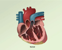 Cardiomyopathy overview