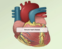 Valvular heart disease (VHD) overview