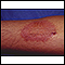 Dermatitis - contact