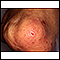 Dermatitis - herpetiformis on the knee