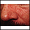 Dermatitis seborrheic - close-up