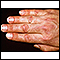 Dermatomyositis - Gottron papule