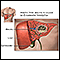 Amebic liver abscess