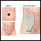 Ileostomy - stoma and pouch