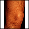 Striae on the leg