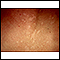 Tinea versicolor - close-up