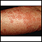 Hives (urticaria) on the arm