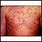 Hives (urticaria) on the chest