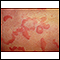 Hives (urticaria) - close-up