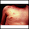 Urticaria pigmentosa on the chest